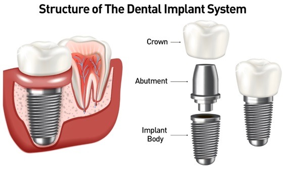Regain Your Smile with Dental Implants in Vadodara