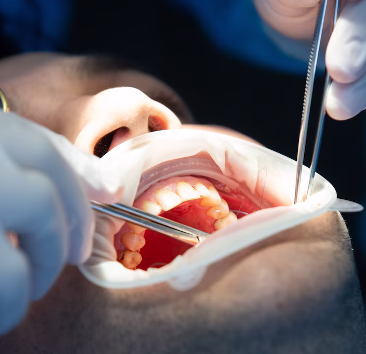 Best Oral & Maxillofacial Surgery in Vadodara at Swastik Dental & Facial Clinic, Karelibaug